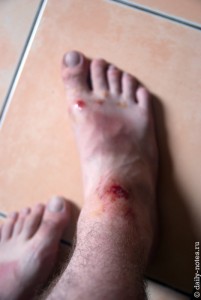Повреждения после падения с байка